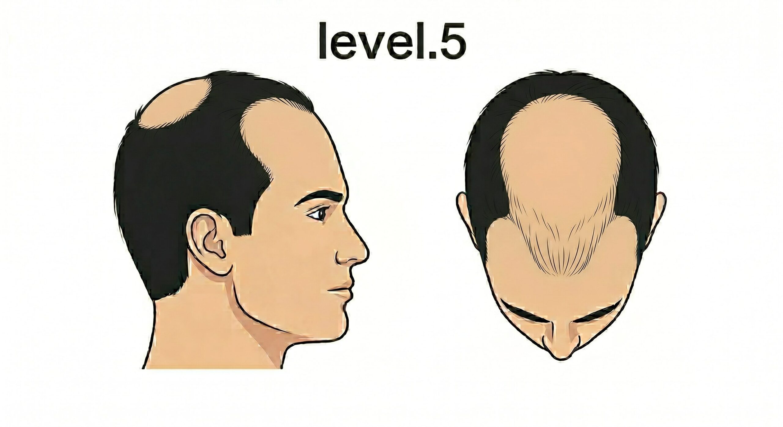 レベル5